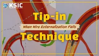 [SUB]Tip-in Technique: When Wire Externalization Fails