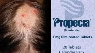 Finasteride Fearmongering and Body Dysmorphia