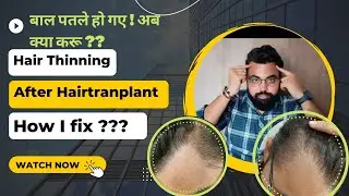 Hair Thinning After Hair Transplant | Hair Thinning Problem