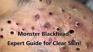 Unlock Safe Blackhead Removal: Expert Tips and Techniques