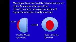 Endoscopic Resection Combined with Laparoscopic Wedge Resection - PG: MIS Colorectal Surgery