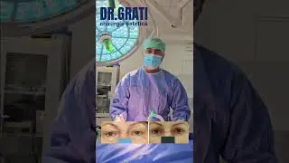Омоложение век. Блефаропластика. Dr. GRATI Sergey #липосакция #подтяжка #chișinău #блефаропластика