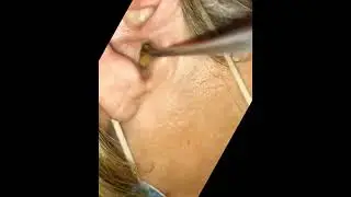ear wax removal | satisfying | bustypoper #shorts