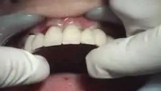 Bionic Teeth