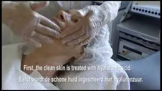 Wrinkle treatment with the Dermapen by Anti Aging Coach, Marjo Horn