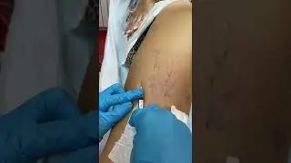 Удаление сосудистых звездочек