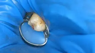 Кариес мезиальной поверхности 17 EvoCeram Sanctuary TorVM (прямой эфир)