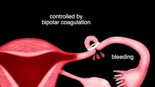Laparoscopic sterilization