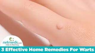 3 Effective Home Remedies For Warts