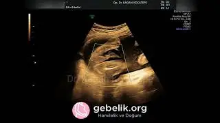 Erkek bebek ultrason görüntüleri, bacak arasından cinsel organı net görülüyor, yanılma payı yok