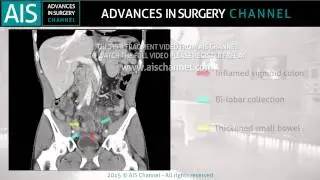 Surgery for complicated diverticulitis. Another lesson learned from the past