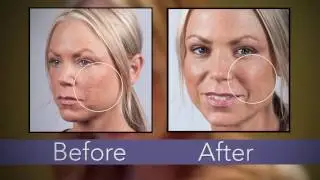 Dermaflage: The Solution for Hiding Acne Scars Chicken Pox Scars Box Car Scars