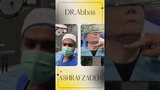 aptos thread lift workshop 2023 in georgia #aptos #threadlift #facelift