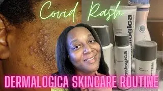 Dermalogica Skin Care Review (Helped Me Get Rid of Severe Acne and Dark Spots) Clear Glowing Skin!