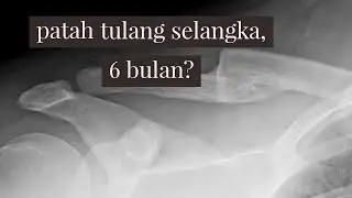 patah tulang selangka sudah 6 bulan, apakah perlu operasi?