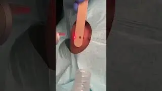 How to remove a mole on the cheek using an Ablative Laser by Quadruple Board Certified Dr. Khorasani