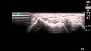 Common Extensor Injection Video.mp4