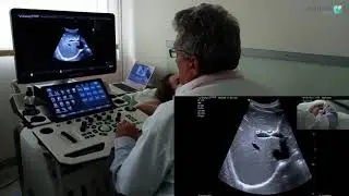 Prezentare examinare ecografică a ficatului, realizată de d-nul Dr. Titus Șuteu - Numeris Medical