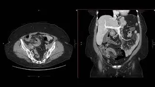 Abdominal Imaging Call Prep Cases: Perforated Appendicitis (CT) Search Pattern