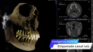 LargeV AI Detección del canal vascular lingual