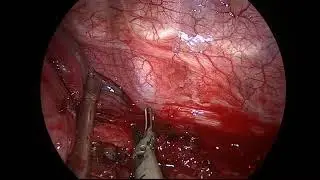 Uniportal VATS Pneumonectomy for Persistent Pneumothorax in a Hypoplastic Lung