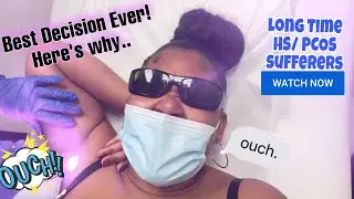 Laser hair removal at Ideal Image! My experience..Helped me with HS! (HIDRADENITIS SUPPURATIVA)