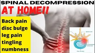 Back Pain Relief with At-Home Spinal Traction - Learn From a Chiropractor