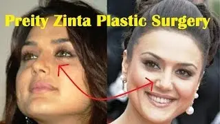Preity Zinta Plastic Surgery Before and After