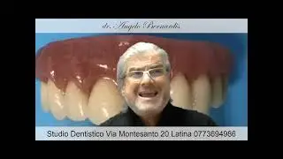 Vantaggi della tecnica “diretta” ed “immediata” per realizzare la protesi, nei Full-Arch #smilelive