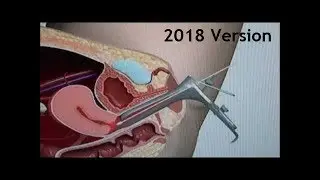 Women's Health - Pap SMEAR (PAP TEST) - Animation Procedure