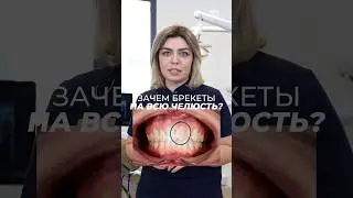 Зачем ставить брекеты на всю челюсть? 