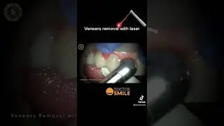 הסרת ציפוי שיניים בלייזר והחלפת ציפויים חדשים - עם ד