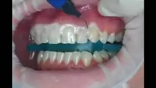 Gingivalna maska