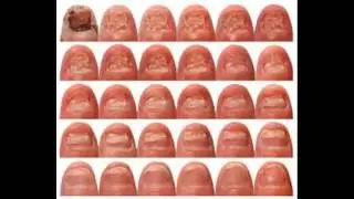 Comment se débarrasser de mycose des ongles