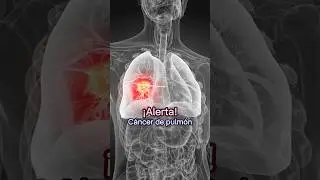 Lung cancer: Don't ignore these signs! | Dr. William Guerrero. 