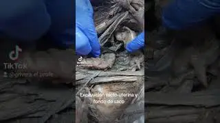 La excavación rectouterina y el fondo de saco de Douglass