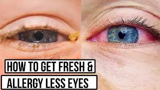 Say Goodbye to Allergy Eyes with These Tips