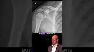 Posterior shoulder dislocation on x-ray