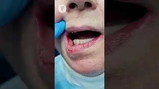 We plan to remove 5 teeth, install 4 implants and temporary teeth. Dental implantation.