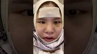 Korean Women BEFORE and AFTER Plastic Surgeries 