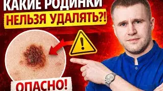 Родинки. Какие нельзя удалять?