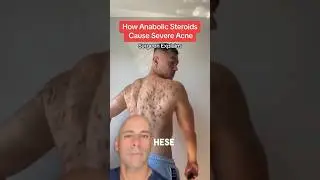 ACNE from Steroids!💉 #shorts