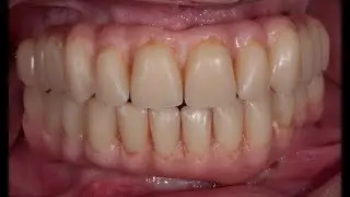dr.Giampiero Ciabattoni Digital Implantology Video Channel