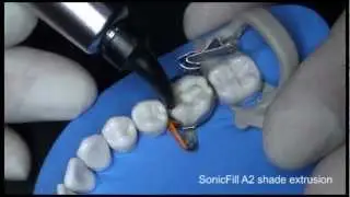 SonicFill - Metafix-XTR