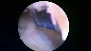 Rotator cuff repair with allopatch bridging graft 12 22 22 SB