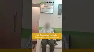 Happy Patient after Hair Transplant || Hair Transplant In Hyderabad || #shorts #ytshorts #treading