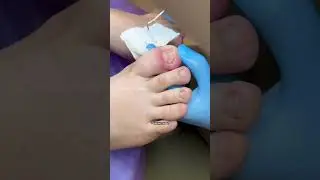 Врастание ногтевой пластины