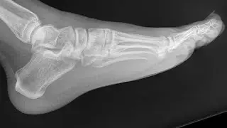 Foot Injury Update LIVE | 2 Weeks Later