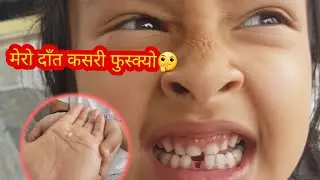 Child Teeth Fall Out !!!! Child Teeth First Fall Down!!!Process Of Child Teeth Fall Out....