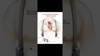 LVAD